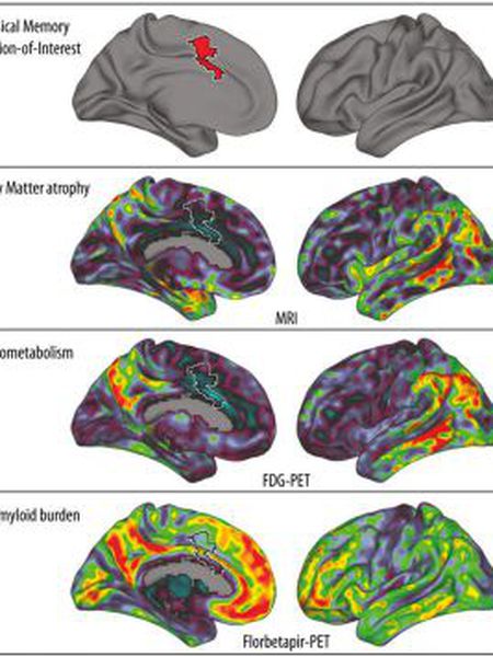 revistaprosaversoearte.com - Alzheimer não afeta memória musical; entenda como isso é possível