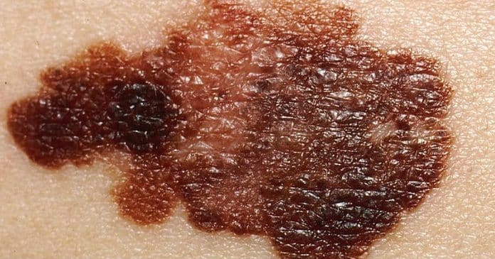 Nova vacina contra câncer de pele reduz em 49% risco de morte e retorno do tumor